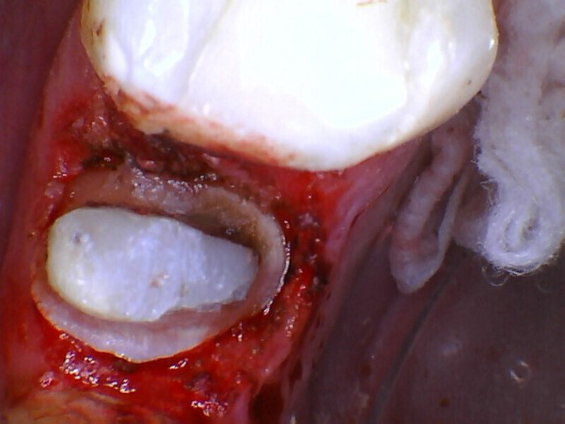 Fig. 16: Core build-up placed and crown preparation completed.