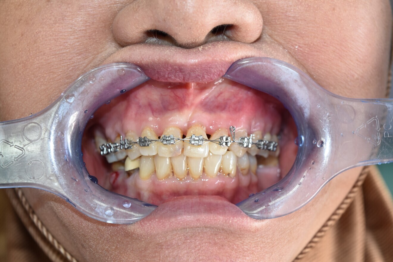  Fig. 5b: Space closed with vertical  closed helix loop 014 stainless steel round wire.