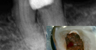 Tratamiento de perforación con el nuevo MTA Repair HP