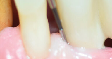 Revisione sistematica della letteratura per la valutazione clinica del sondaggio perimplantare