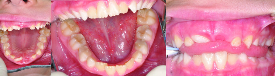 Figs. 1 (a, b & c). An 8 ½ year old girl presented with delayed eruption of 21 and a palpable palatal swelling. Lower teeth were carious; see bitewings in Figure 4