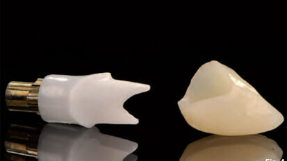 Customised abutments for long-term aesthetics