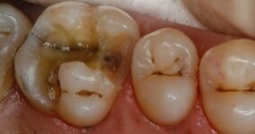 Nuevo detector de caries Facelight