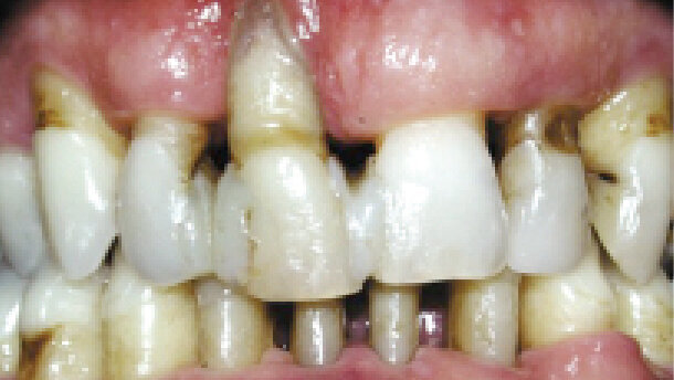 Kde končí parodontologie a nastupuje implantologie
