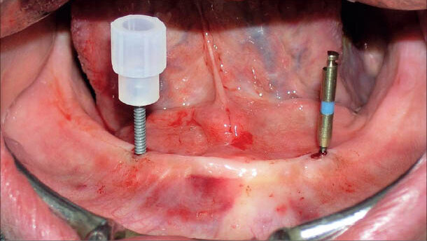 Stabilizace protézy v dolní čelisti – MDI Mini Dentální Implantáty