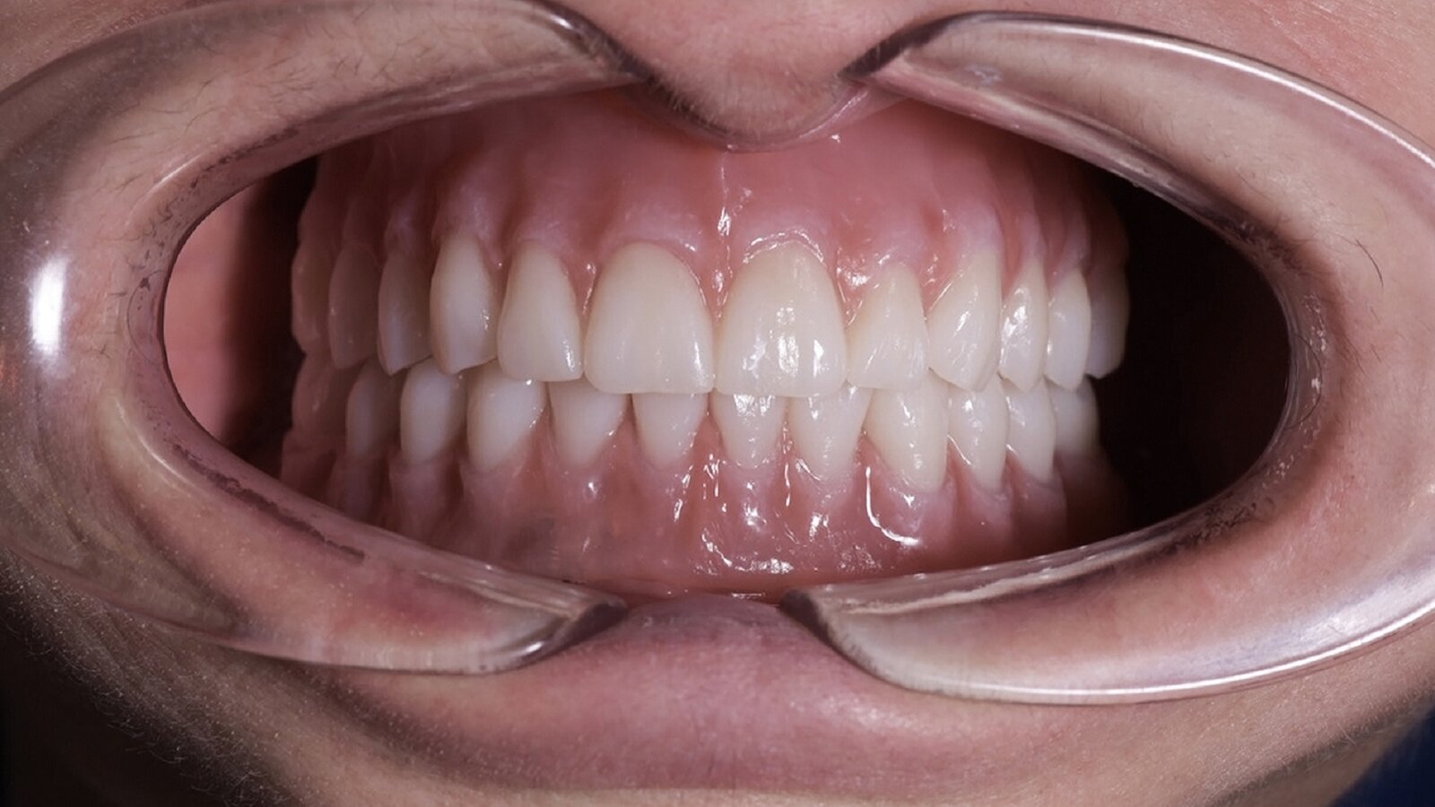 Production of complete maxillary and mandibular dentures using CAD/CAM technology