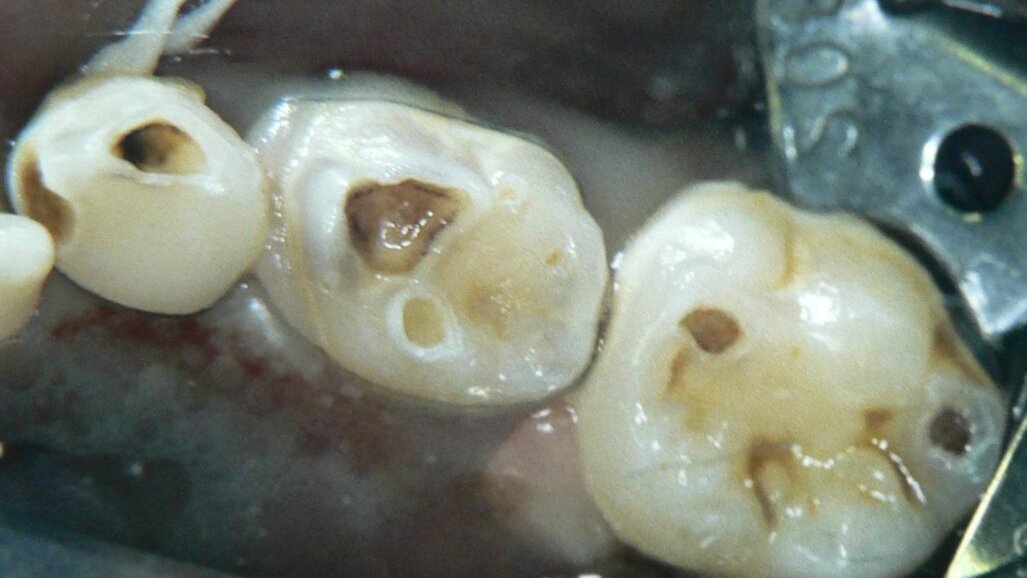 סילוק עששת סלקטיבי בנגעי עששת עמוקים לעומת סילוק עששת בשני שלבים