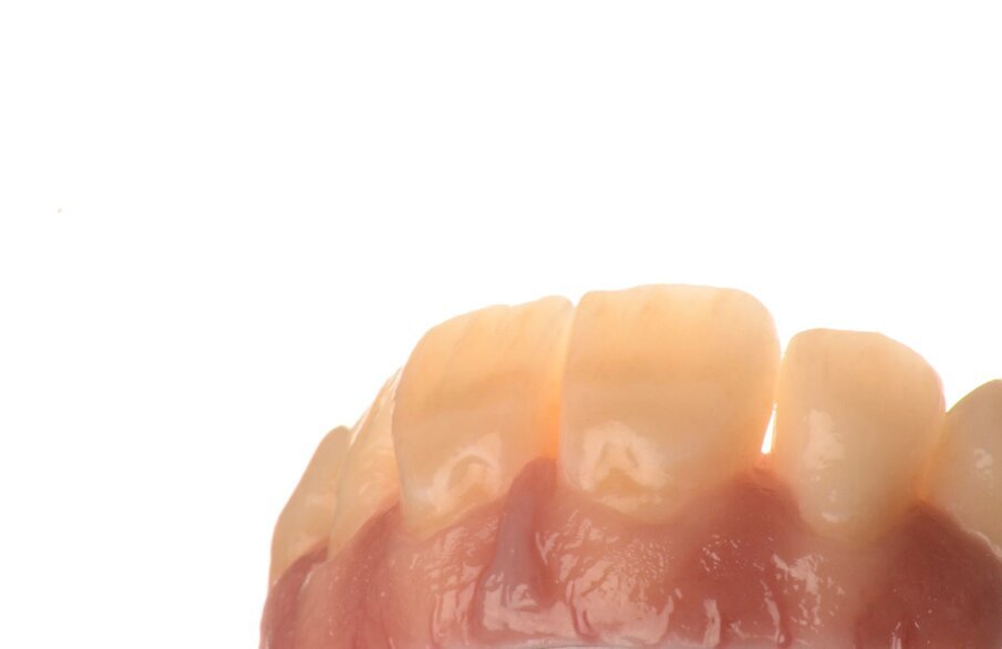 Fig. 27b: Polished gingiva and teeth, view from two different angles.
