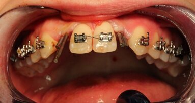 Wszczepy igłowe w hipodoncji siekaczy bocznych szczęki ze skrajnie cienkim wyrostkiem zębodołowym