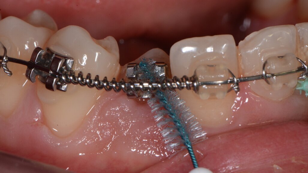 Il controllo del biofilm batterico nello spazio sovracrestale con approccio clinico personalizzato Tailored Brushing Method