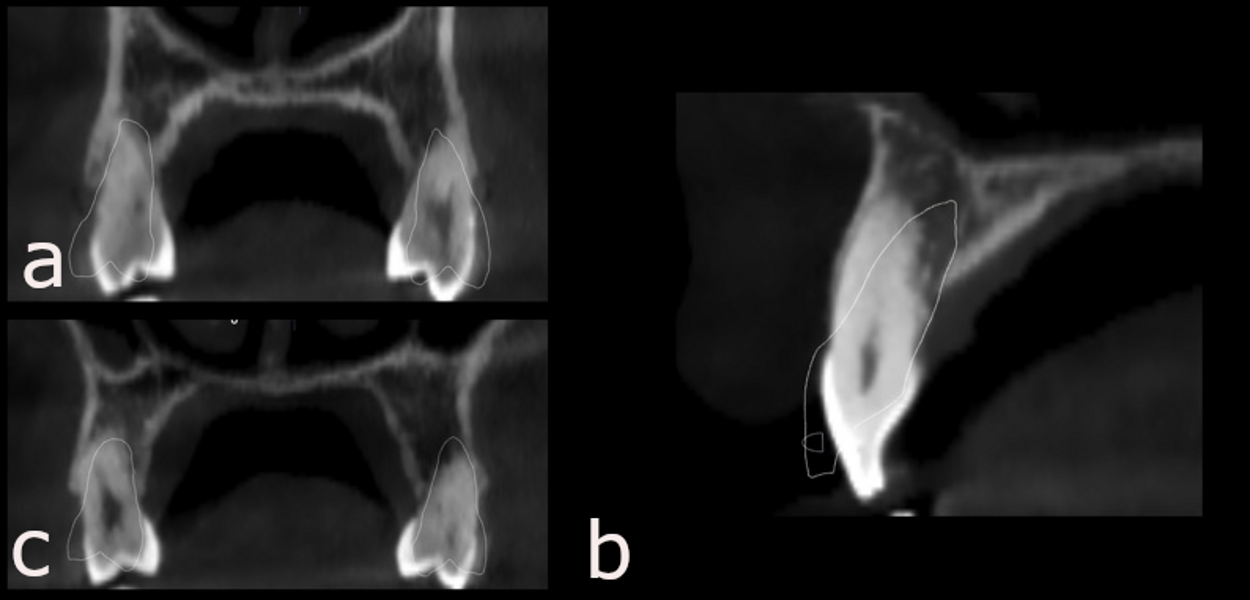 Figs. 46a–c: 3D superimpositions of the planned torque movements on to the CBCT images. (a) Maxillary first premolars. (b) Central incisor. (c) Maxillary second premolars.