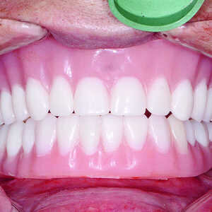 Fig-16-Prothèses-immédiates-rebasées-par-un-matériau-souple-300x300-