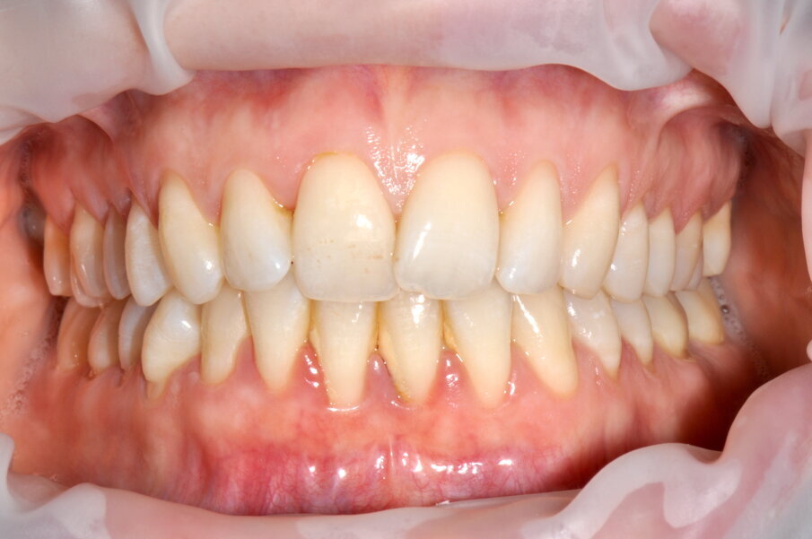 Figg. 6a-6d - Confronto fra stato iniziale e alla valutazione a 2 settimane (6a, 6c), il rilevatore di placca (6b, 6d) mostra chiaramente il miglioramento della compliance del paziente.