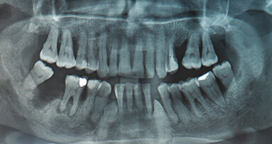 Protesi rimovibile superiore e inferiore su barra