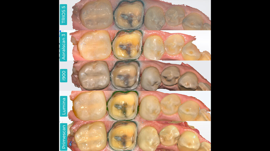 Fig. 3 - Scansioni a colori elaborate sulla base della stessa preparazione dentale, visualizzate in anteprima nel software nativo dello scanner. TRIOS 5 (a). Aoralscan 3 (b). Medit i900 (c). ITero Lumina (d). CEREC Primescan (e).