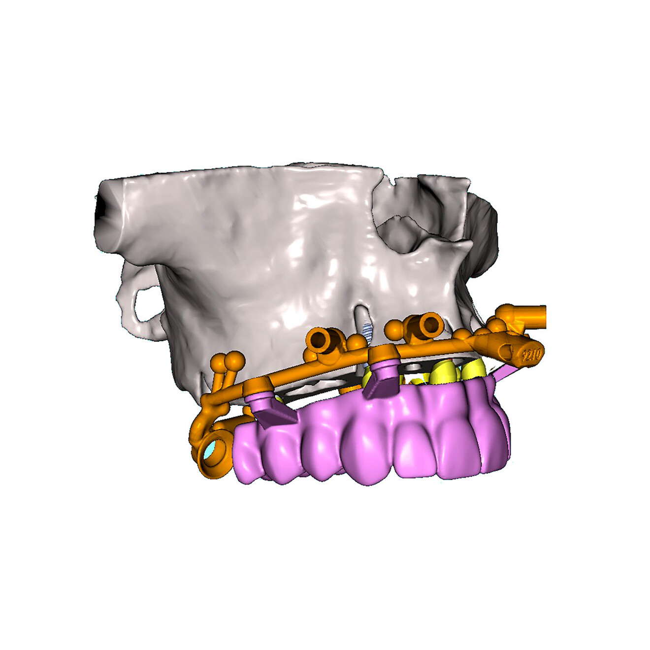 Fig. 15b: Lateral view of the provisional prosthesis seated on the base frame.