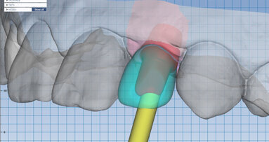Plně digitální implantologické workflow