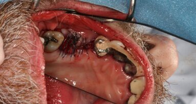 Les propres cellules souches du patient récoltées et transplantées dans sa mâchoire.