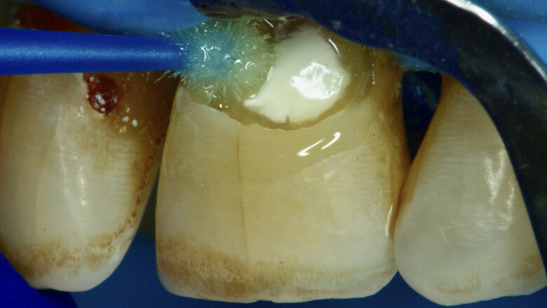 Figuras 14 y 15. Aplicación del adhesivo de autograbado de dos pasos Forma.