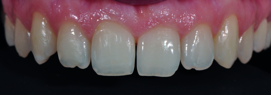 Fig 4c) : vue intraorale de face. 