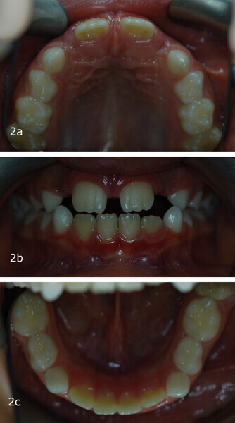 Figs. 2a–c: (a–c) Intra-oral photographs and ...
