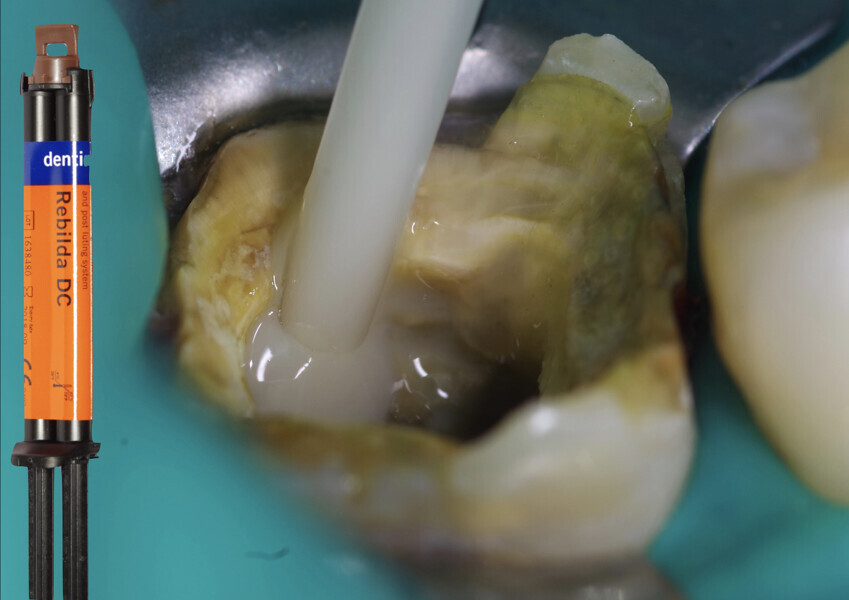 Fig. 8: Floor of the cavity and undercuts covered and sealed with Rebilda DC.