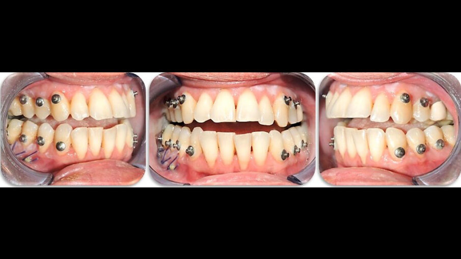 Fig. 8_Immagini intraorali 7 giorni dopo l’intervento, con un morso aperto tra le arcate, un evento comune in questi tipi di chirurgia.