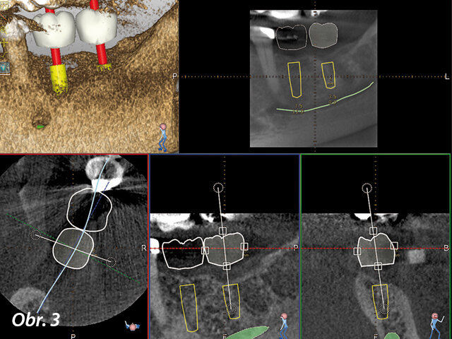 Pacient mohl vidět navrhované ošetření zobrazené softwarem Navident