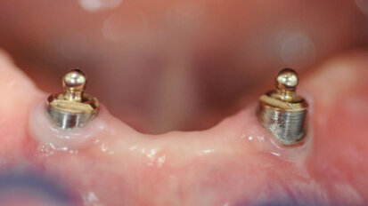 Riabilitazione di paziente già portatore di protesi con overdenture su due ball attachment preesistenti e usurate