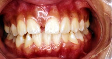 Dientes supernumerarios. Casos clínicos