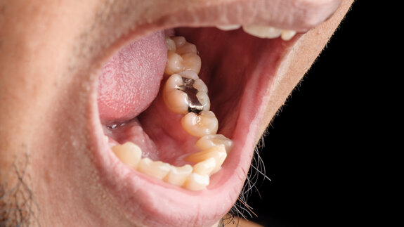 Weltgemeinschaft beschließt Aus für quecksilberhaltiges Amalgam bis 2034