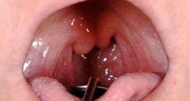 Gespleten huig indicatie voor stofwisselingsziekte