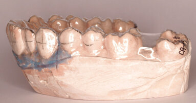 Protocolo de tratamiento de CA® CLEAR-ALIGNER en uno, dos o tres pasos a partir de mismo modelo