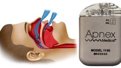 Un neurostimulateur semblable à un stimulateur cardiaque, pour éviter l'apnée du sommeil