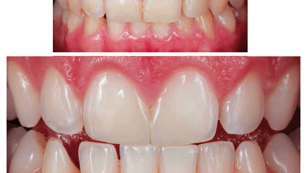 Restauraciones estéticas en la clínica diaria