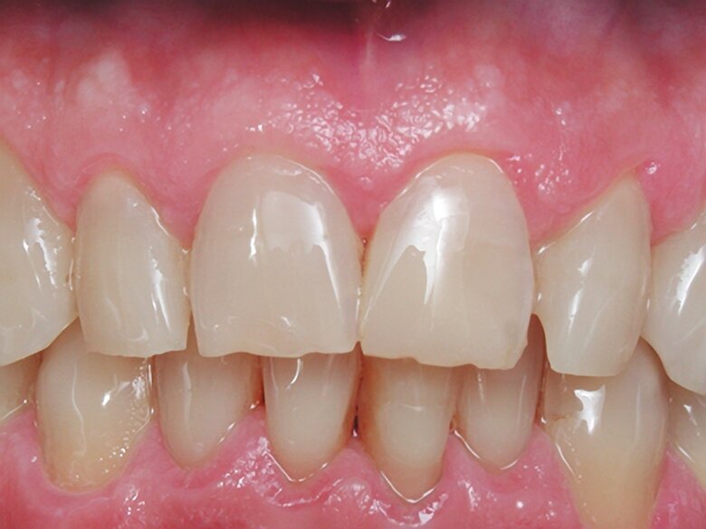 Figura 4. Caso terminado, imitando la naturaleza.