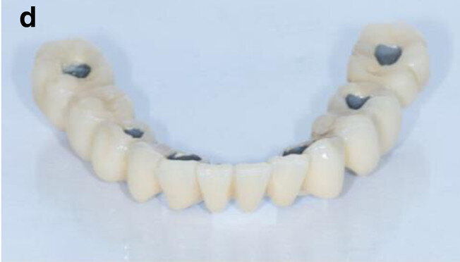 Fig. 7d: CAD/CAM model with the prefabricated titanium abutments (a), CAD/CAM cobalt–chromium framework (b) and composite veneered provisional FDP (c & d) before bonding to the abutments.
