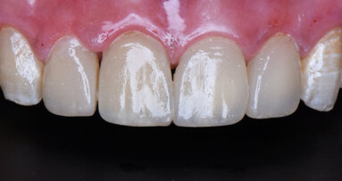 The Dentsply Sirona Global Clinical Case Contest 2018-2019