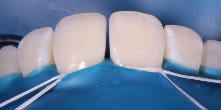 Fig 7. Free Hand Front wing for 11