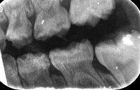 Afbeelding 5b. Bitewings bij intake.