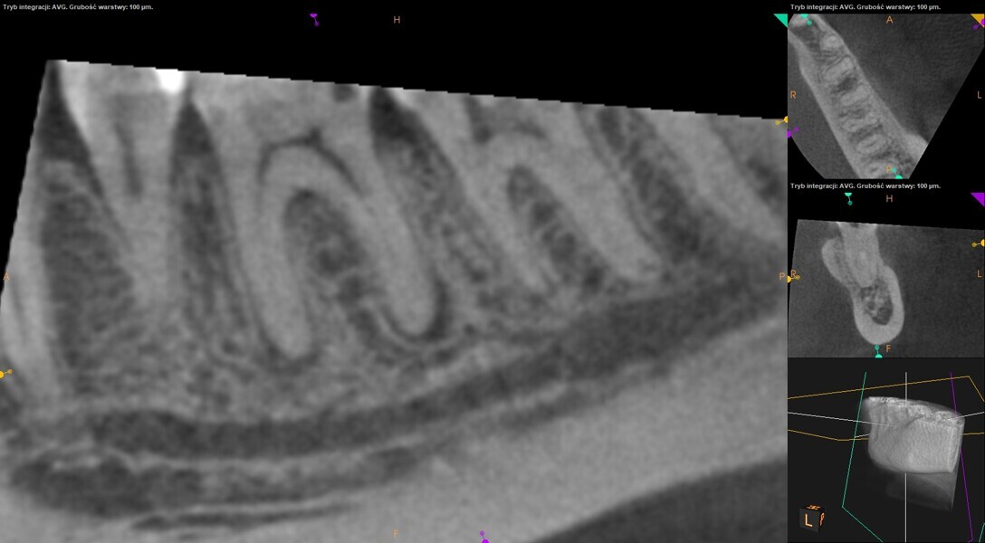 Fig. 27: Pre-op CBCT image of the mandibular first molar.