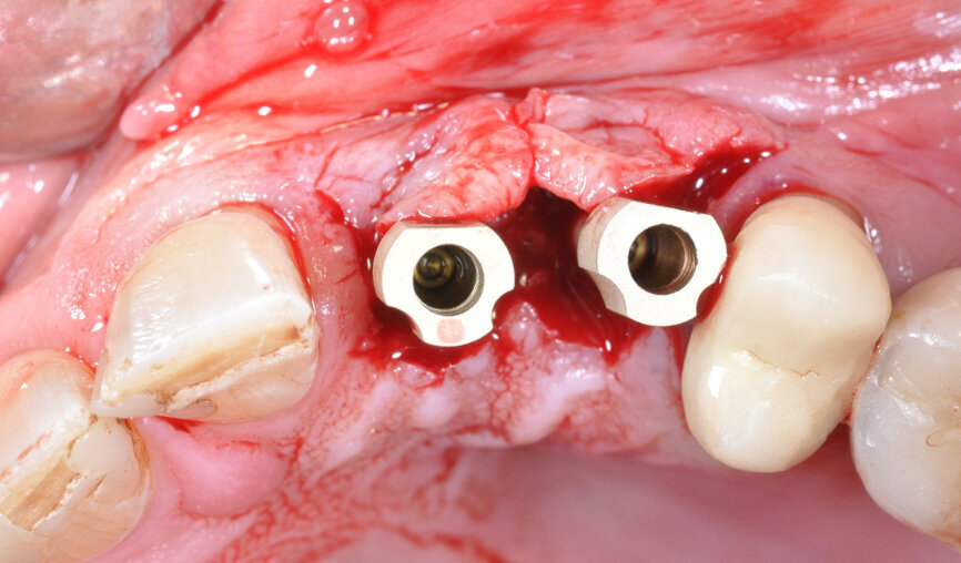 Scan bodies for the intra-op scan for manufacturing of the new PEEK gingiva formers from Camlog. (Image: Inga Boehncke)