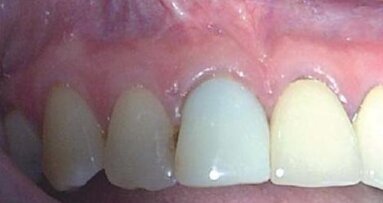 Rewizja leczenia endodontycznego po nieudanej resekcji wierzchołka korzenia