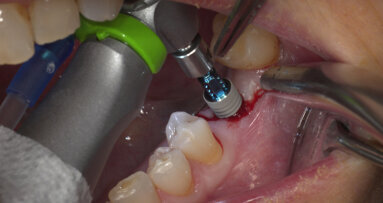 Conventional and immediate loading with final n!ce screw-retained crowns