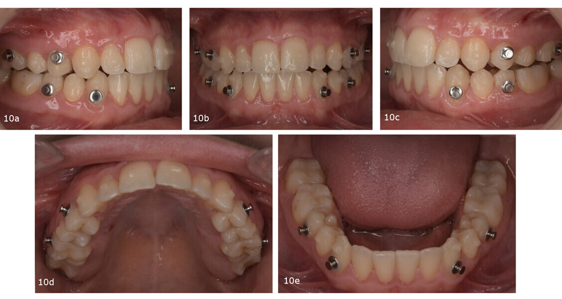 Figs. 10a–e: Finishing phase with aligners.