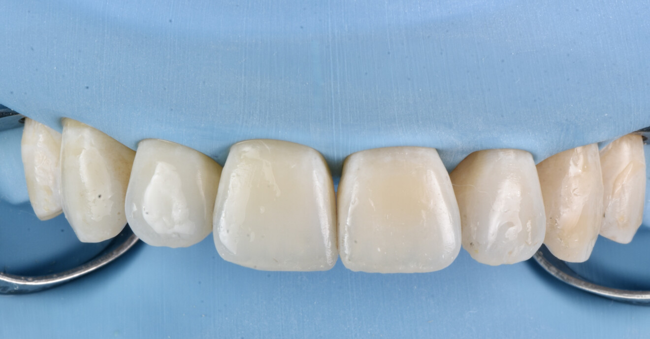 Figg. 10, 11 - Restauro margini incisali.