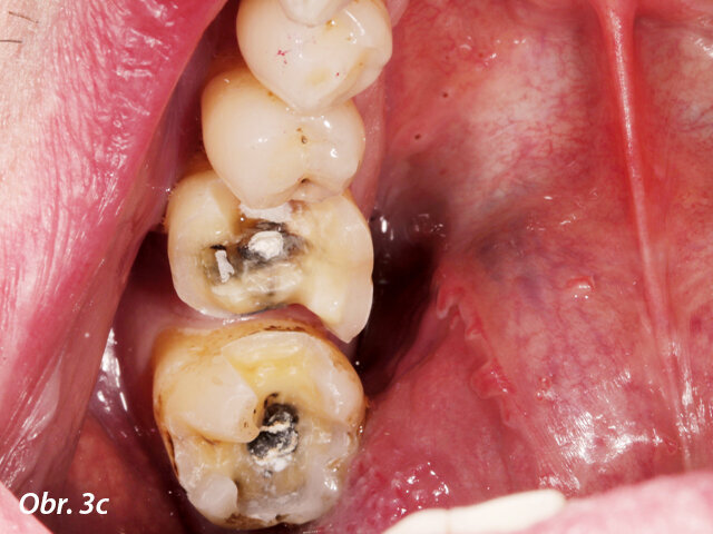 Preparované zuby jsou připraveny na intraorální digitalizaci (intraorální skenování).