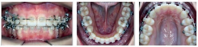 6 months later (at 23 months)