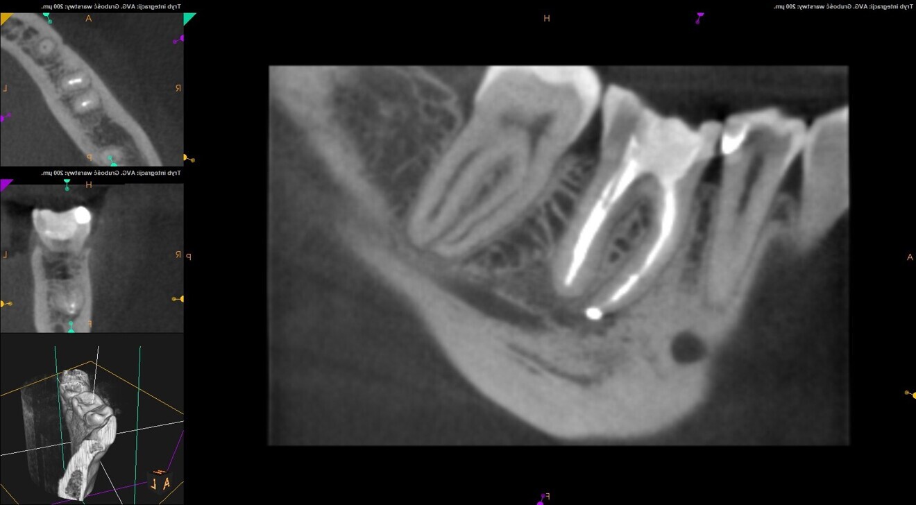 Fig. 24: CBCT scan at the six-month follow-up.