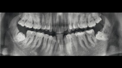 Un caso di IIa Classe con morso aperto e mancanza dell’incisivo centrale destro inferiore, trattato ortodonticamente con un trattamento ibrido con allineatori